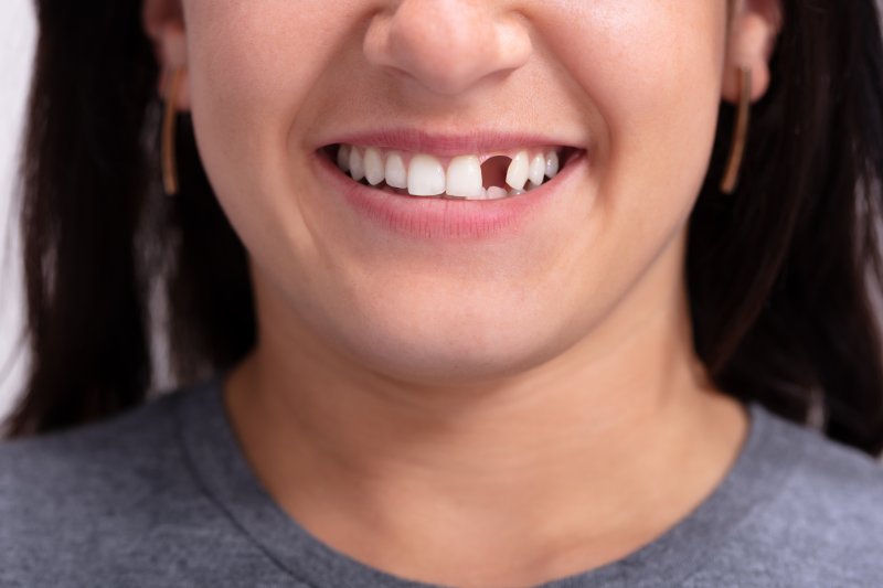 A woman smiling with her knocked-out-tooth