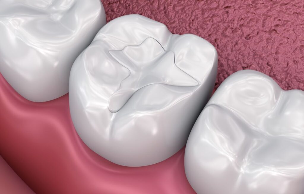 A CGI of a composite resin filling
